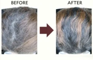 Purality Health Hair Renewal Before and after